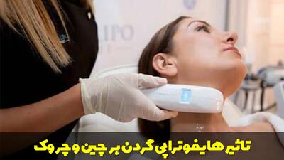  هایفوتراپی گردن؛ بررسی کامل روش، نتایج و تاثیر آن بر چین و چروک